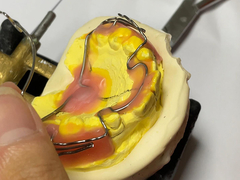 Προσαρμοσμένη ορθοδοντική συσκευή με καλή διατήρηση και ρυθμιζόμενα χαρακτηριστικά