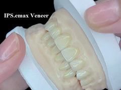Η IPS.emax Veneer Premium αισθητική λύση για εντυπωσιακές μεταμορφώσεις χαμόγελου