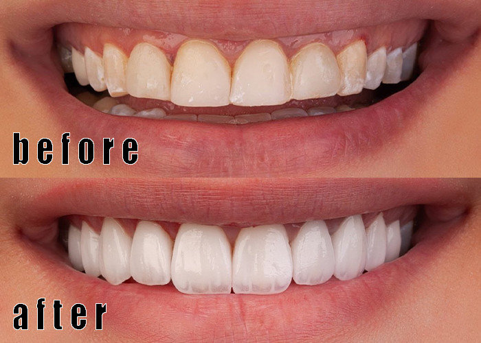 Τελευταίες εταιρικές υποθέσεις Επεξεργασία ελαστικών emax 1