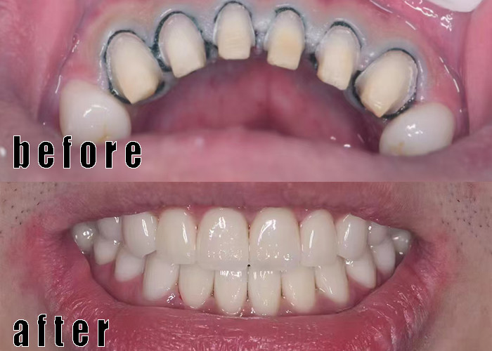 Τελευταίες εταιρικές υποθέσεις κορώνα zirconia