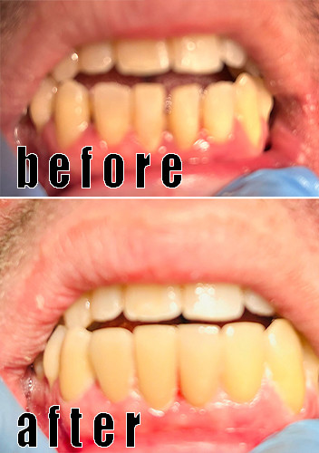 Τελευταίες εταιρικές υποθέσεις Η ελαστική Emax χρησιμοποιήθηκε για να κλείσει το ανοιχτό δάγκωμα