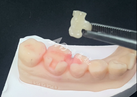 Αγορά Η Emax Κεραμικά Ενθέματα Onlays Οδοντικές Αποκαταστάσεις για φυσικό χρώμα δοντιών και εύκολη συντήρηση online manufacture