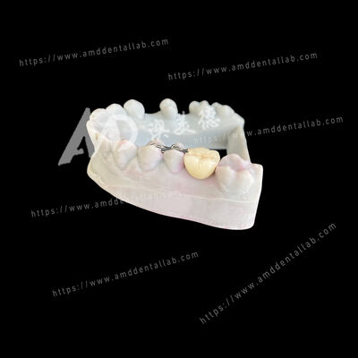 Αγορά PFM Maryland Bridge One Pontic Two Wings Μια συντηρητική και αισθητική λύση online manufacture