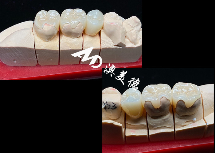 OEM Precision Fit Ceramic Inlays Onlays για ανθεκτικές και φυσικές οδοντικές αποκαταστάσεις με ανώτερη αντοχή και αξιοπιστία