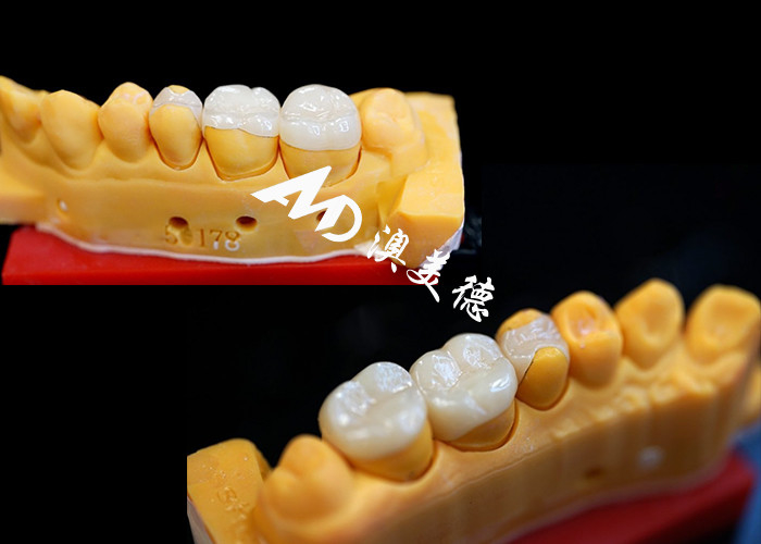 OEM Precision Fit Ceramic Inlays Onlays για ανθεκτικές και φυσικές οδοντικές αποκαταστάσεις με ανώτερη αντοχή και αξιοπιστία