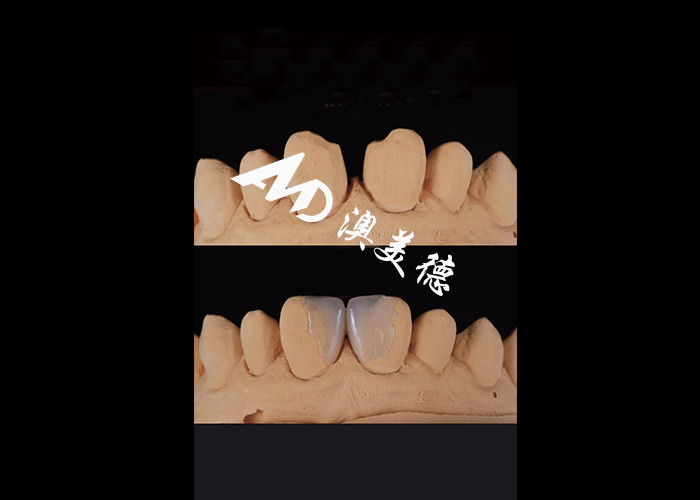 0.3-0.5mm Υπερ λεπτές IPS EMAX πορσελάνες για αισθητικές αλλαγές στο χαμόγελο