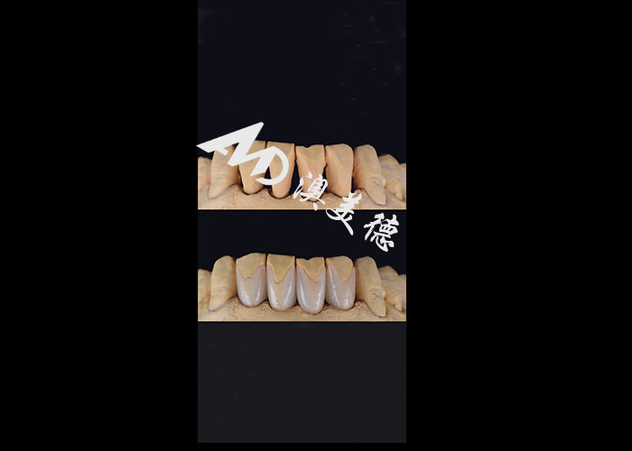 0.3-0.5mm Υπερ λεπτές IPS EMAX πορσελάνες για αισθητικές αλλαγές στο χαμόγελο