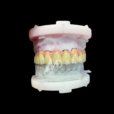 Καλή τιμή Καθαρό τιτανίου κεραμικό στέμμα και γέφυρα ανθεκτικό ελαφρύ αισθητικό αποκατάσταση σε απευθείας σύνδεση